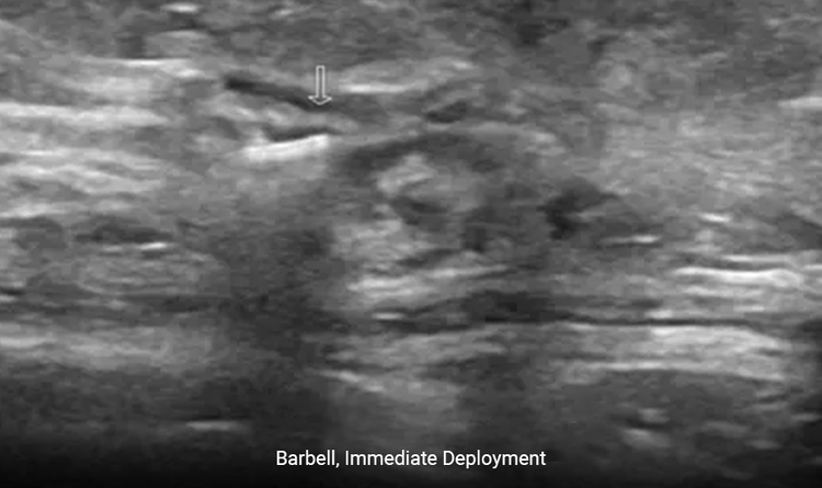 Ultrasound image of BiomarC® biopsy site marker in tissue