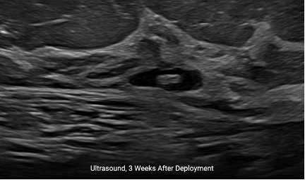 El marcador HydroMARK™ tres semanas después de la inserción