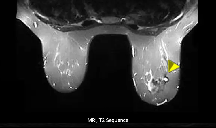 The HydroMARK™ markers are uniquely distinguishable under MRI