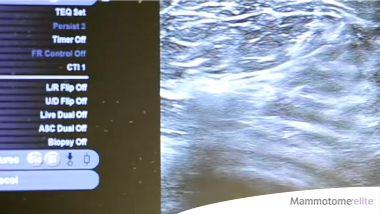 Mammotome® Elite Procedural Video