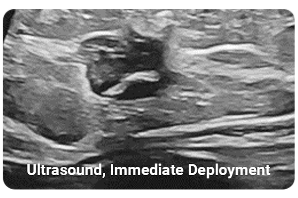 hydromark plus marker is visibily under ultrasound at deployment