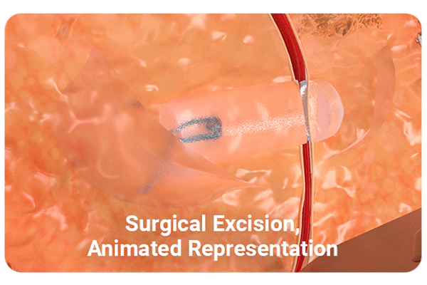 illustration showing surgical excision of hydromark plus breast marker