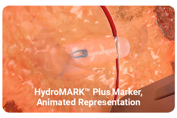 placement stability of Mammotome Marker during surgical excision
