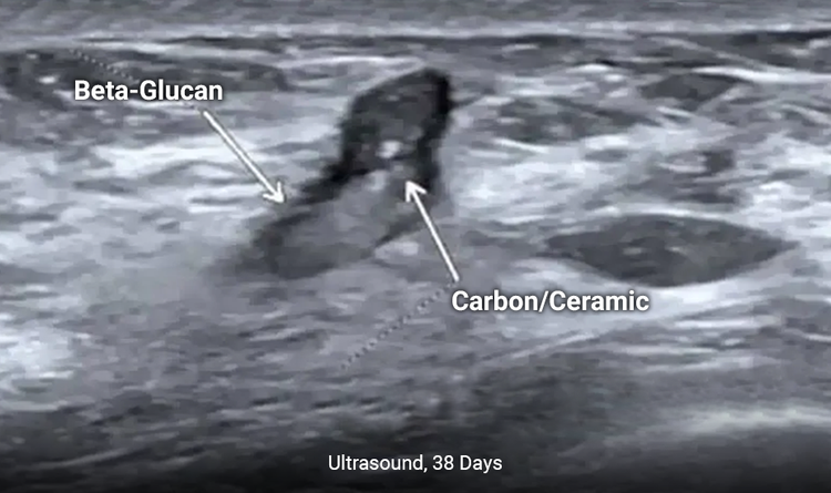 The MammoSTAR® marker has enhanced long-term ultrasound visibility under ultrasound