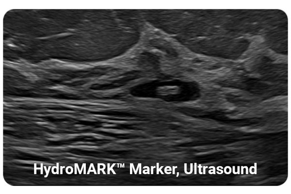 Mammotome Markers with long-term ultrasound visibility