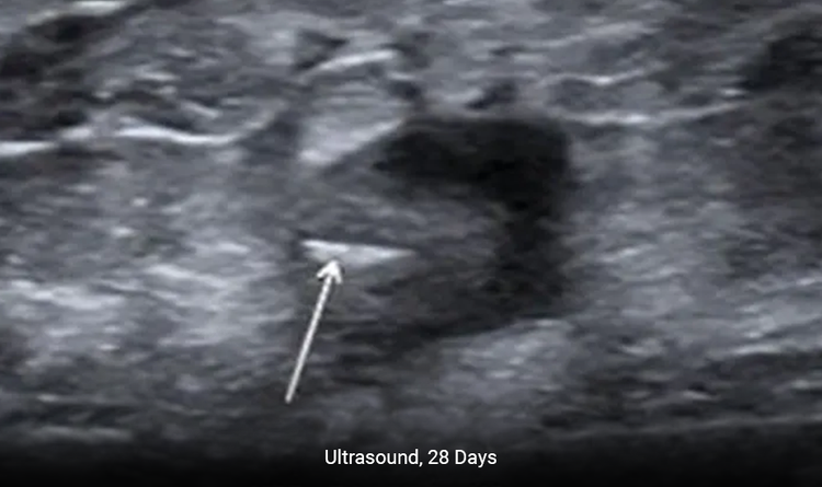 MammoMARK® & CorMARK® markers help with accurate placement under ultrasound