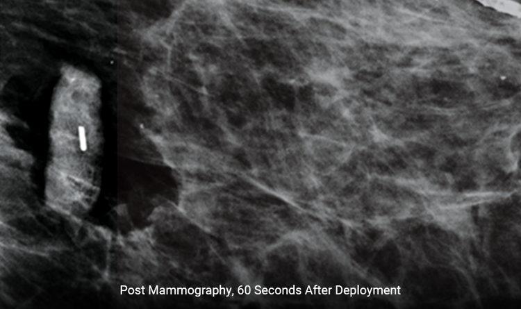 MammoMARK® & CorMARK® markers expand rapidly to reduce movement after breast compression during mammography