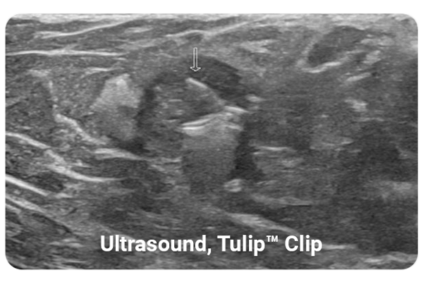 LumiMARK Tulip Clip seen under ultrasound