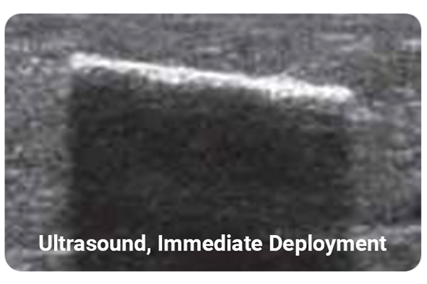 MammoMARK marker seen in ultrasound after deployment