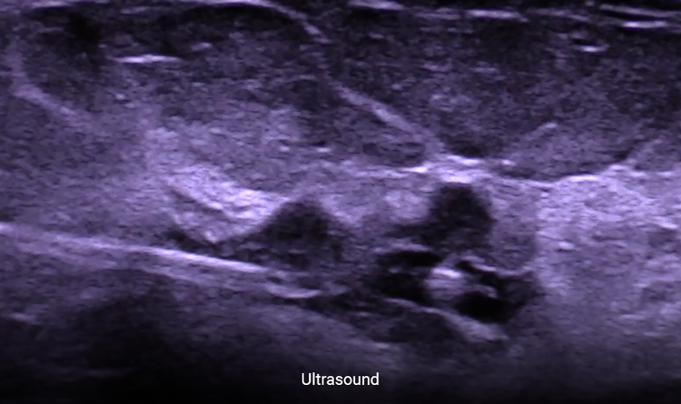 The HydroMARK™ marker is easier to place any localization device under ultrasound