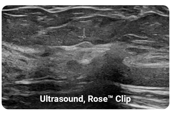 LumiMARK marker Rose clip seen under ultrasound
