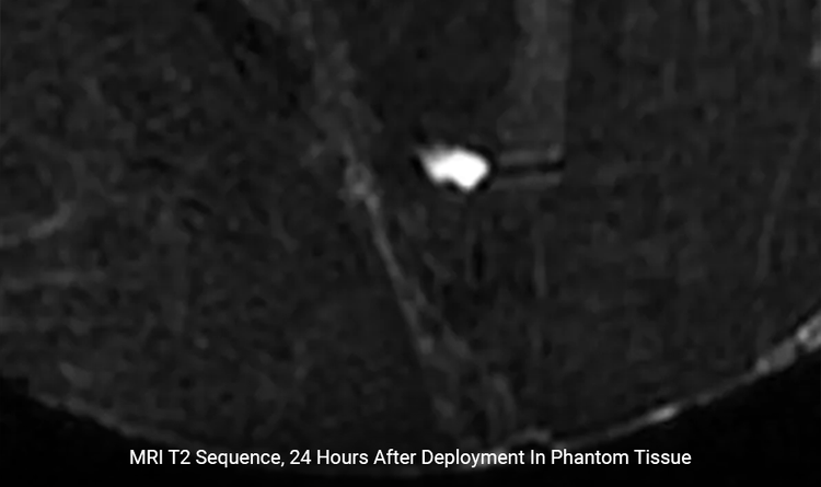 HydroMARK™ Plus marker on MRI 24 hours after deployment