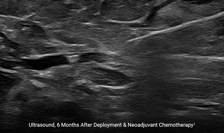 The HydroMARK™ marker is still visible under ultrasound 6 months after deployment, even after neoadjuvant chemotherapy