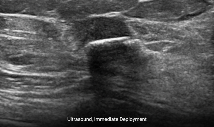 MammoMARK® & CorMARK® markers are visible under ultrasound at time of deployment