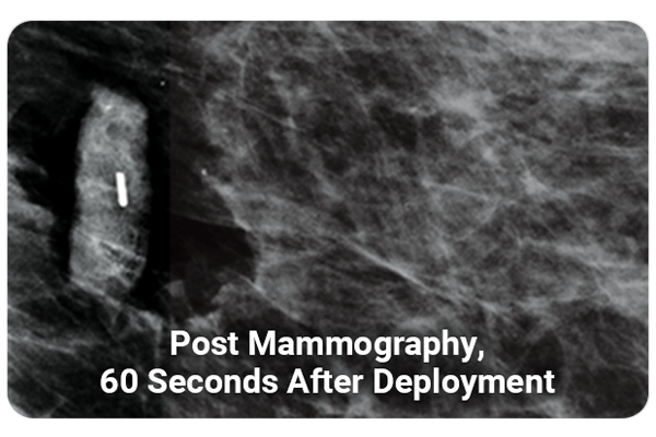 MammoMARK marker seen in Mammography after deployment