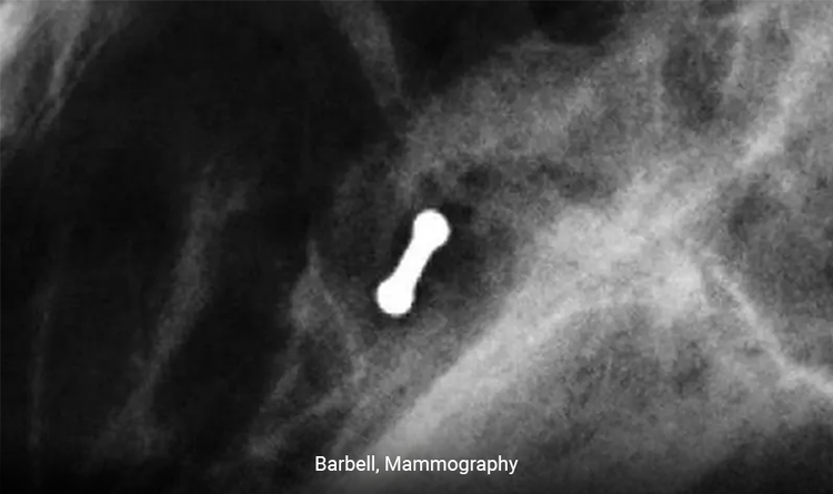 Mammography image of BiomarC® biopsy site marker