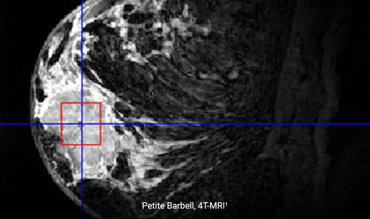 MRI image of BiomarC® biopsy site marker in the breast