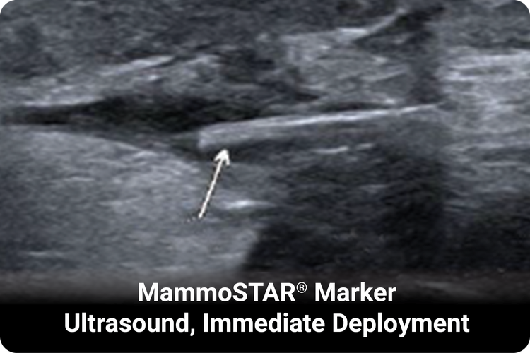 MammoSTAR marker seen under ultrasound