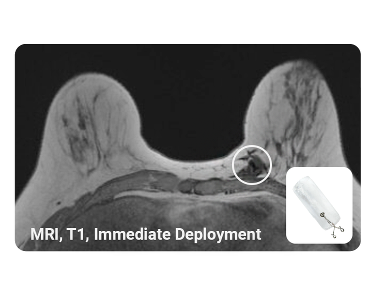 MRI image of HydroMARK Plus marker after insertion into the breast