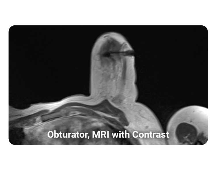 Obturator, MRI with Contrast