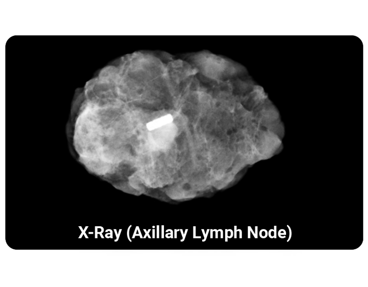 Pintuition marker is easily visible on x-ray