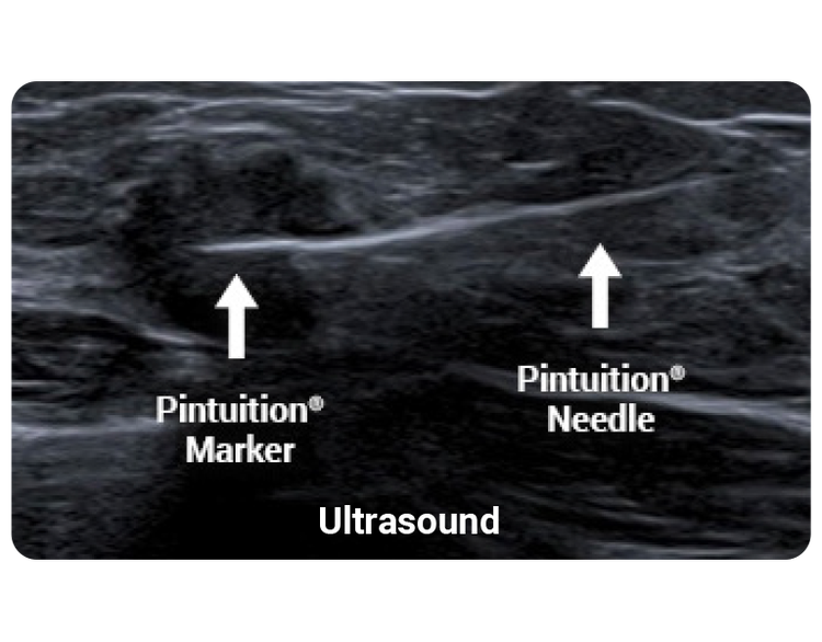 Pintuition marker and needle are highly visible under ultrasound
