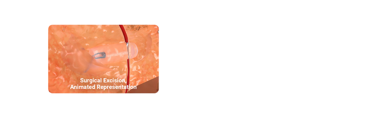 illustration showing surgical excision of hydromark plus breast marker