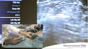 Watch the Mammotome Elite procedure video