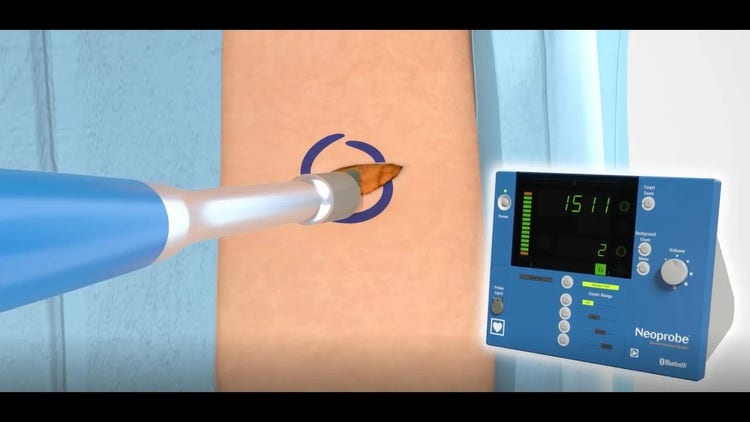 Watch the Neoprobe GDS for Melanoma Procedure Animation, Picture