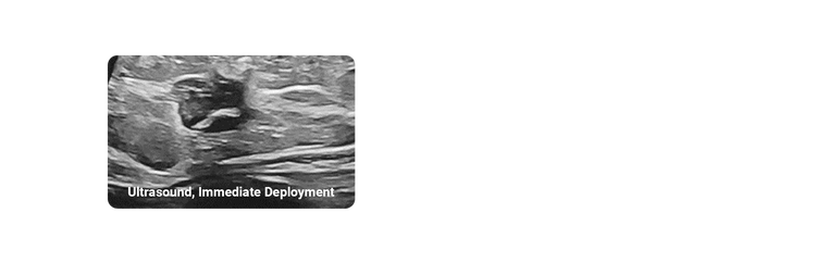 hydromark plus marker is visibily under ultrasound at deployment